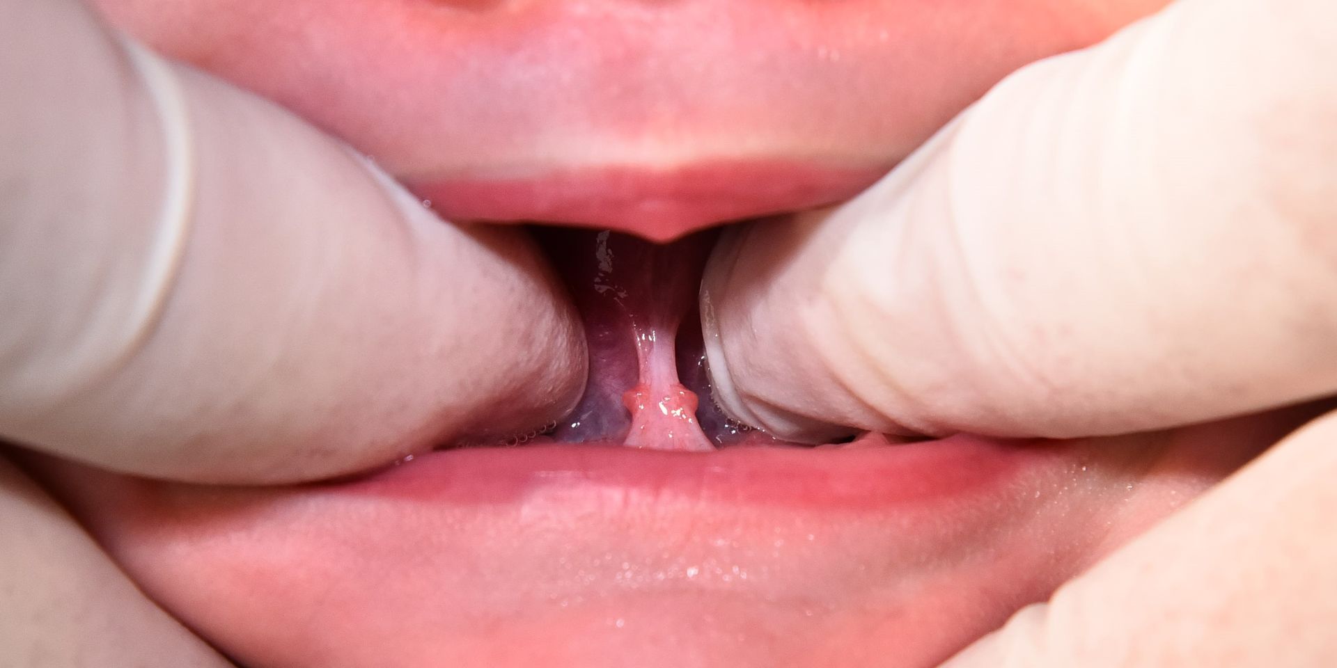 Babys mund undersøges med tandlægeredskaber af handskebeklædte hænder, lys baggrund.