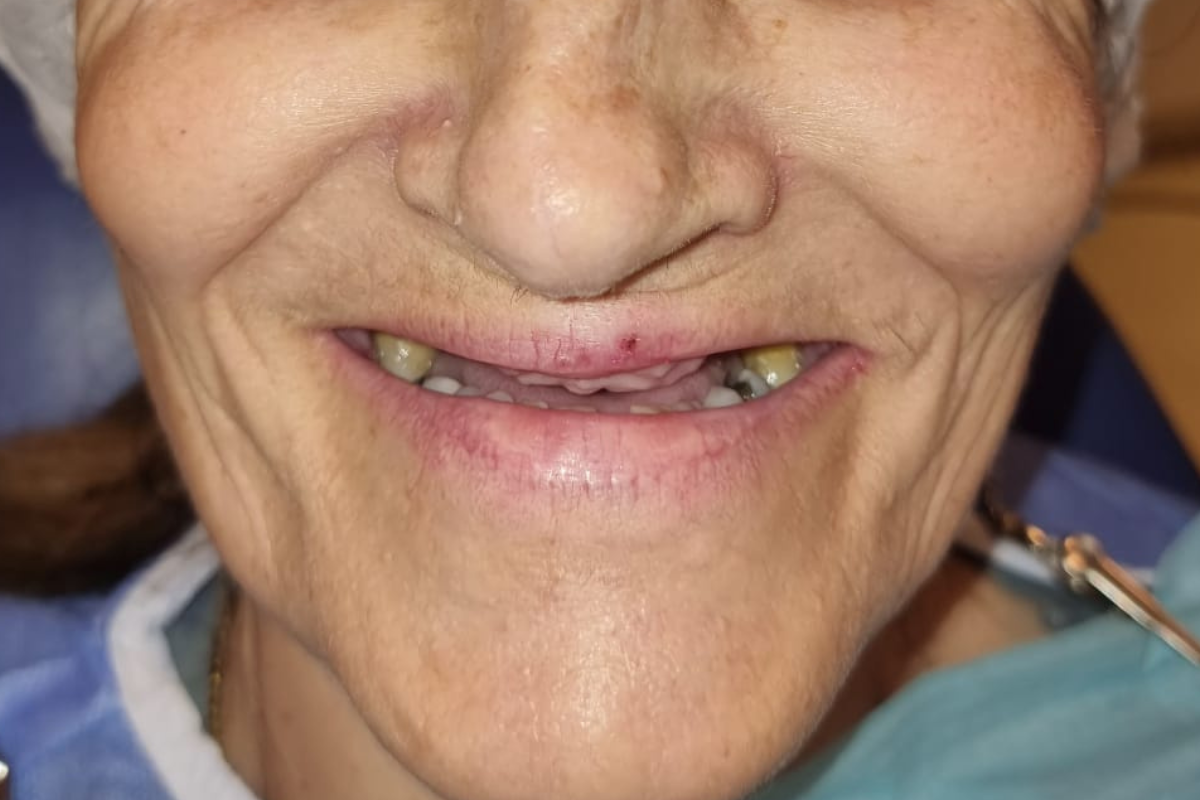 Antes do tratamento com perda dentária e sorriso comprometido
