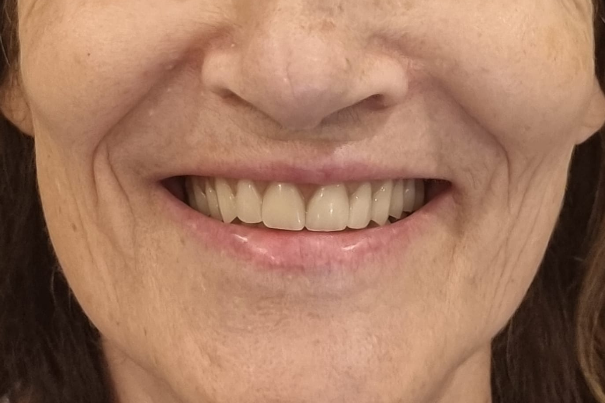 Depois do tratamento com sorriso reabilitado