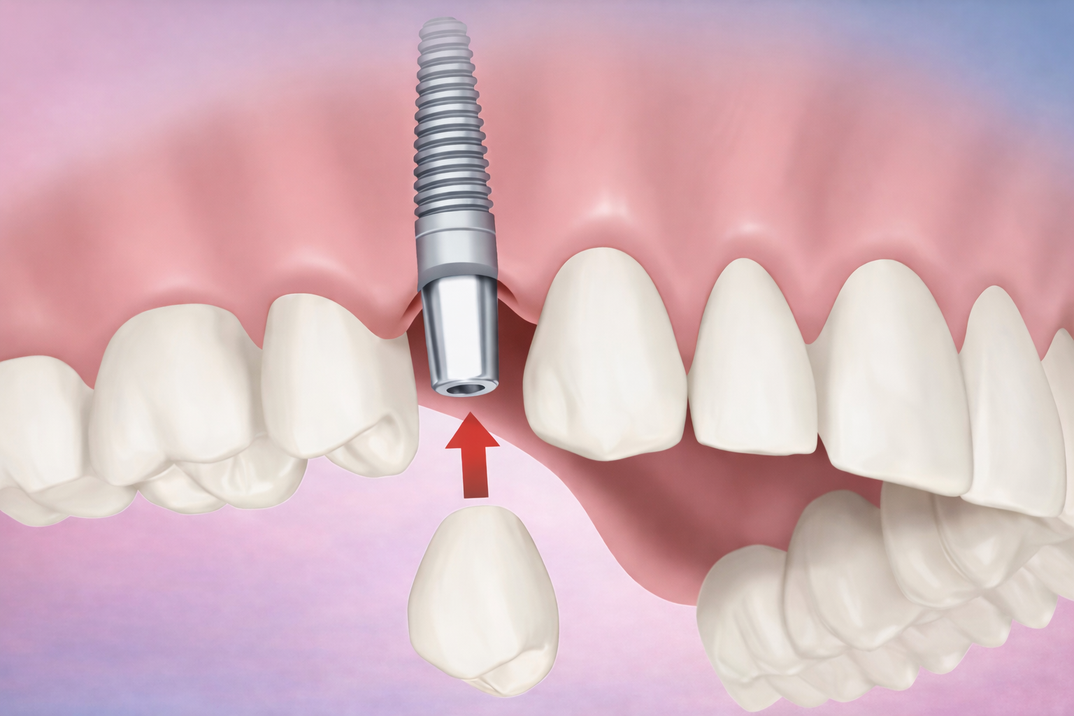 Implante com carga imediata em modelo dentário

