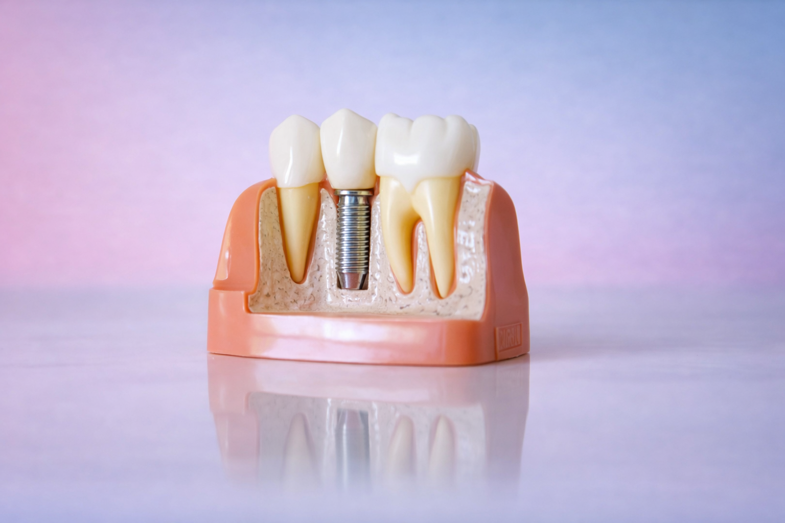Implante unitário em modelo dentário

