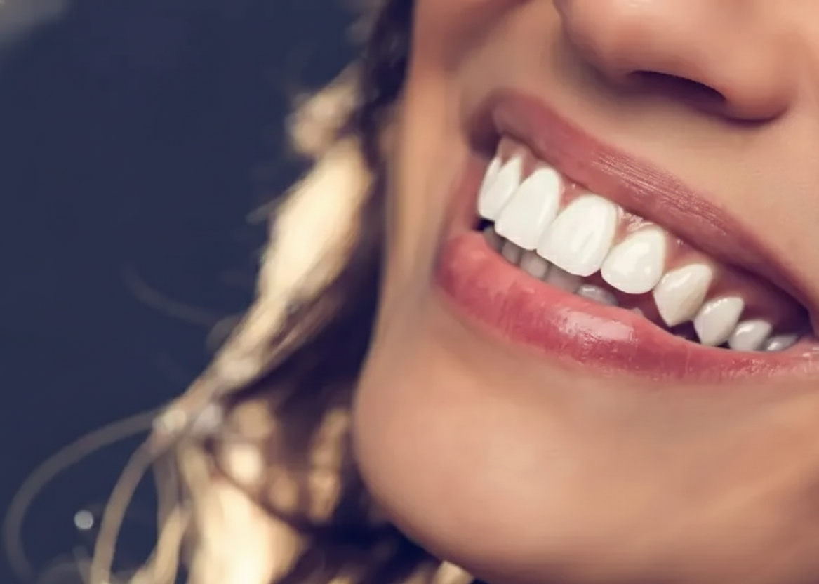 Sorriso com lentes de contacto dentárias
