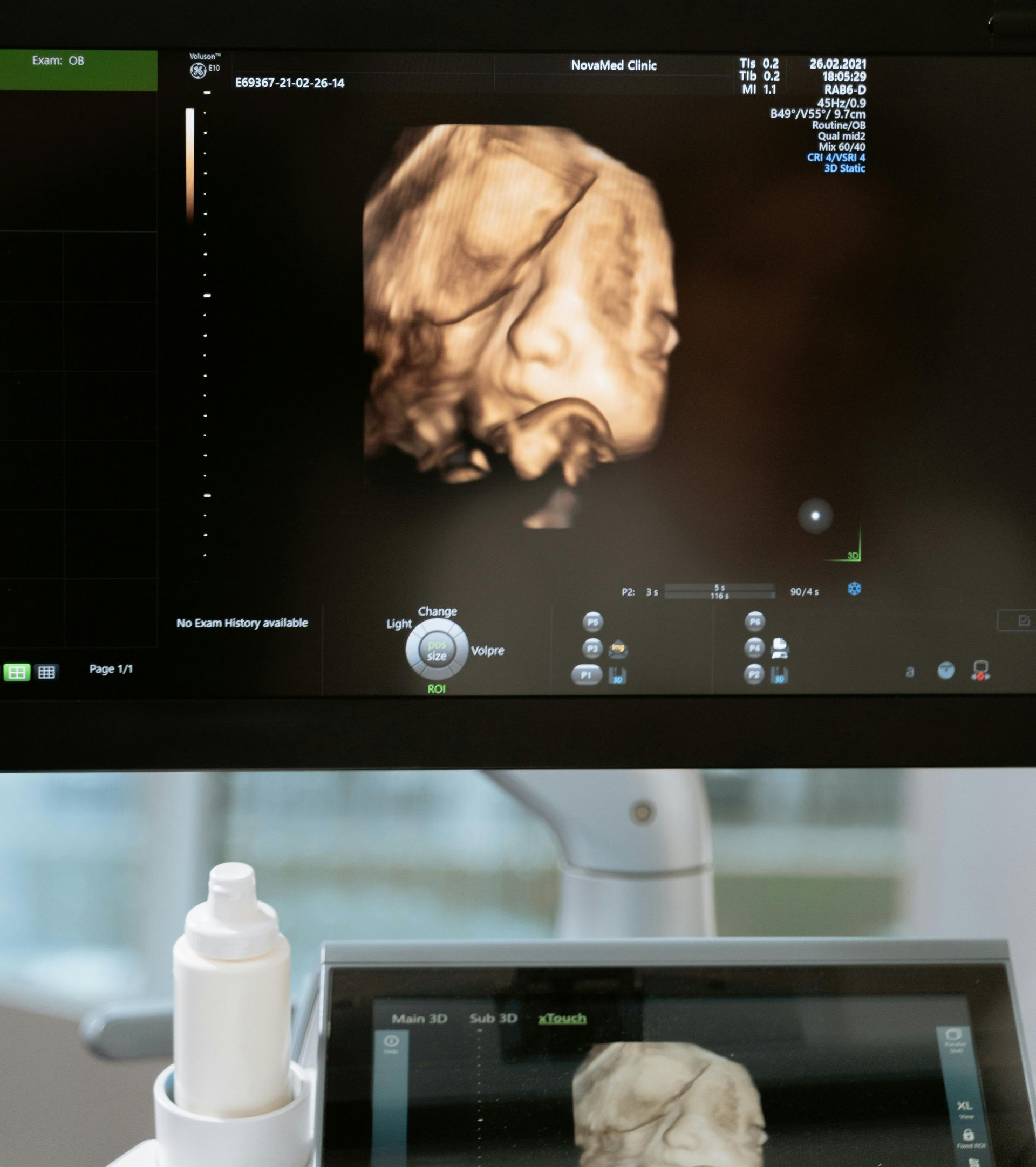 A 3D ultrasound screen shows a baby's face, taken in a medical setting.