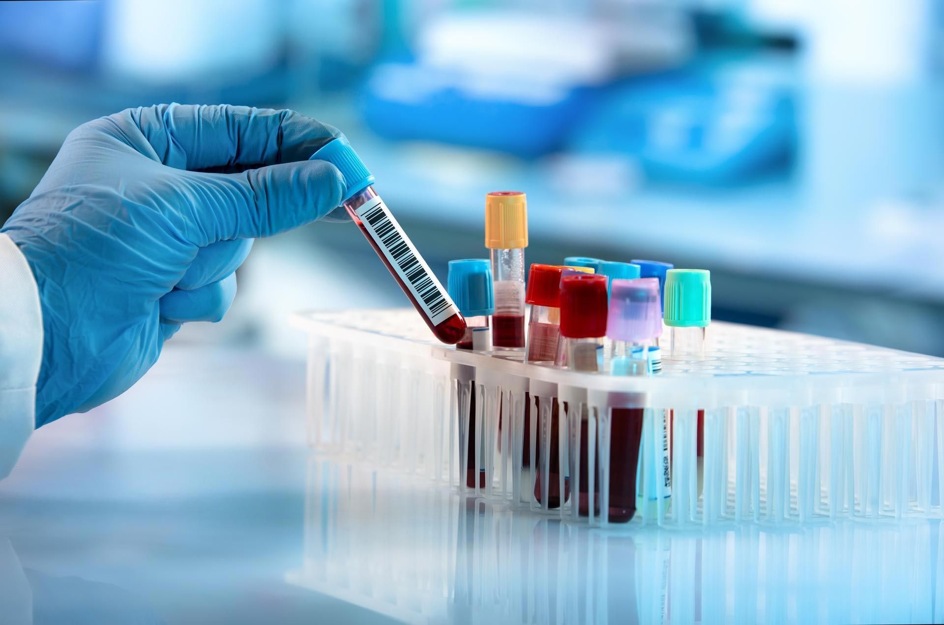 Blood Testing — Los Angeles, CA — Randox Health Labs