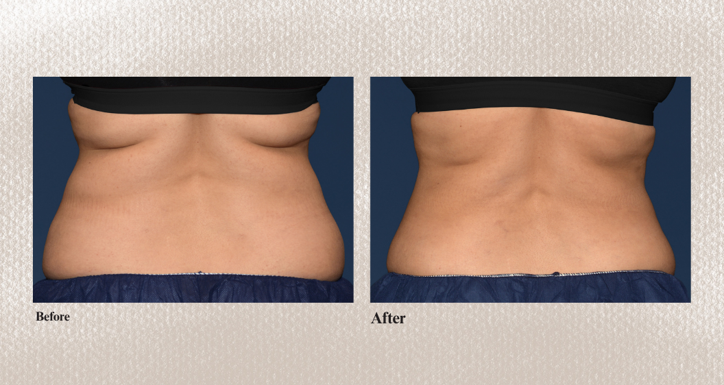 Bra Fat and Love Handles