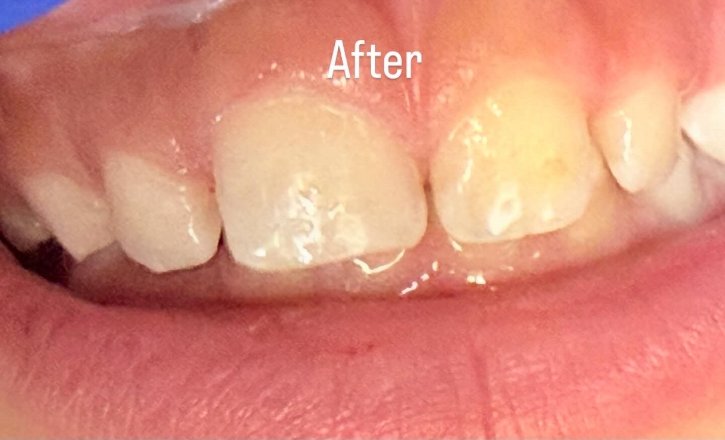 Close-up of teeth after dental work, showing a child's mouth with white teeth and pink gums.