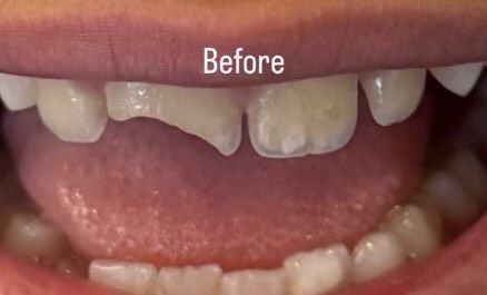 Close-up of child's mouth showing chipped and damaged front teeth labeled 