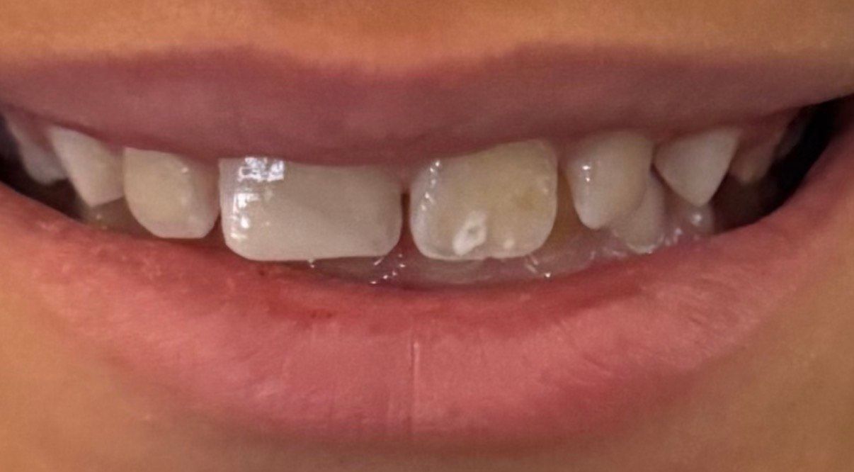 Close-up of a person's teeth, showing a gap between the front teeth. Other teeth are visible.