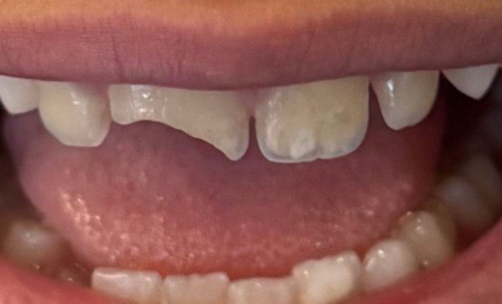 Close-up of a mouth with visible front teeth, one chipped, with a pink tongue.