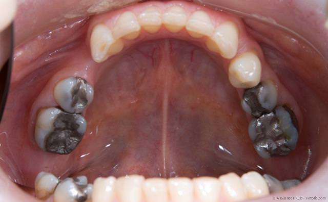 Amalgam kann der Auslöser für viele Störungen und Erkrankungen sein.