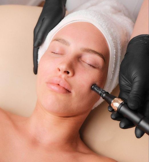 Microneedling Behandlung Kosmetikstudio Hannover List