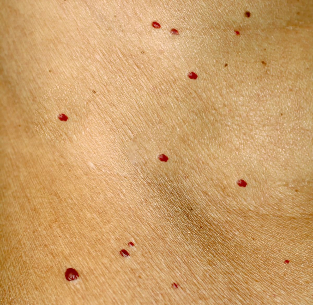 Close-up of bright red cherry angiomas on skin representing cherry angioma removal treatment in Albuquerque.