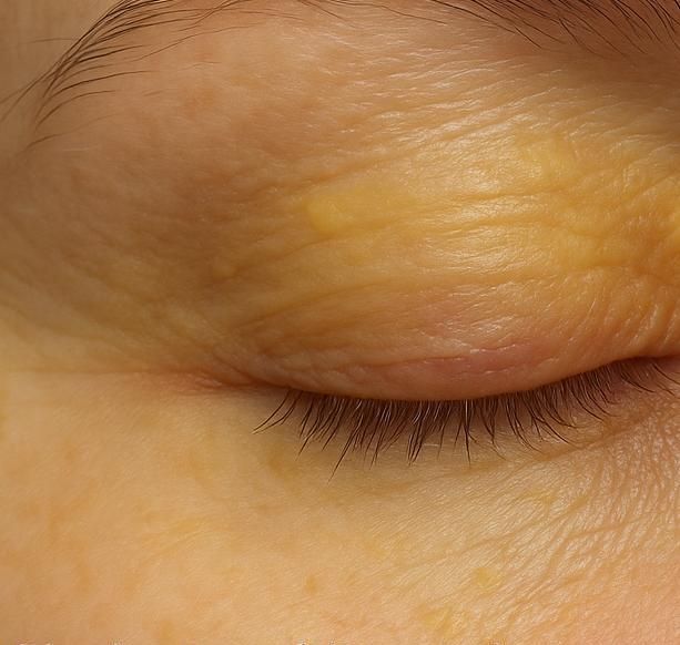 Close-up of yellowish discoloration around eyelid representing cholesterol deposit removal treatment in Albuquerque.