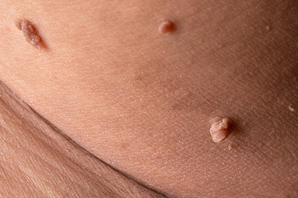 Close-up of small, firm skin growths on neck illustrating fibroma removal treatment in Albuquerque.