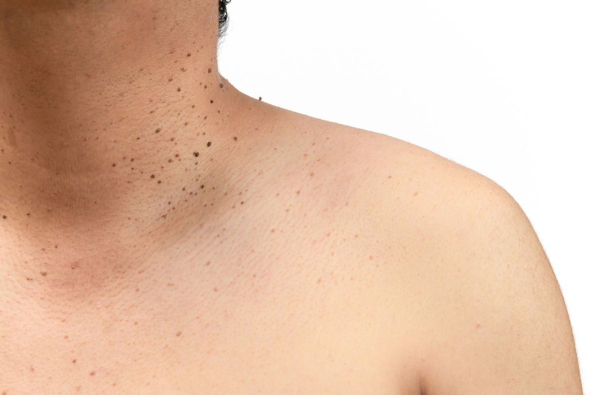 Close-up of rough, raised keratosis spots on skin illustrating keratosis treatment in Albuquerque.