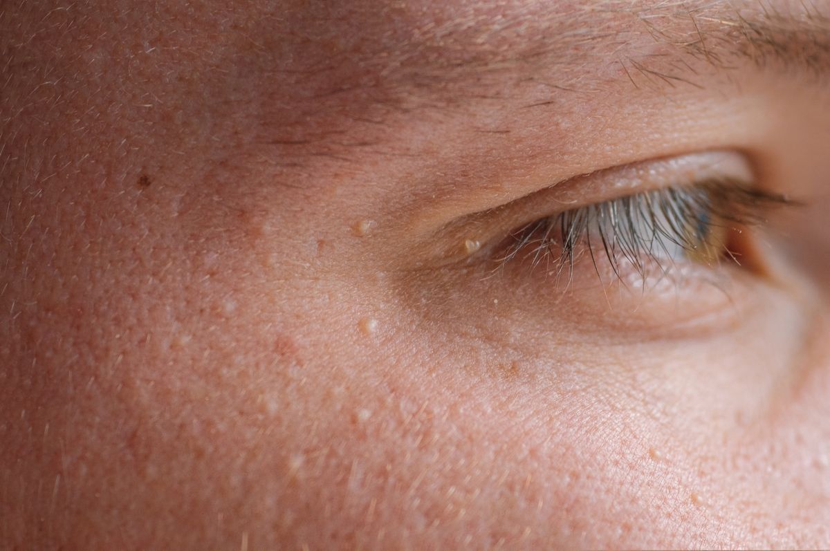 Close-up of small white milia bumps near eye illustrating milia removal treatment for clearer skin in Albuquerque.