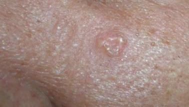 Close-up of enlarged oil glands on skin illustrating sebaceous hyperplasia treatment for smoother skin in Albuquerque.