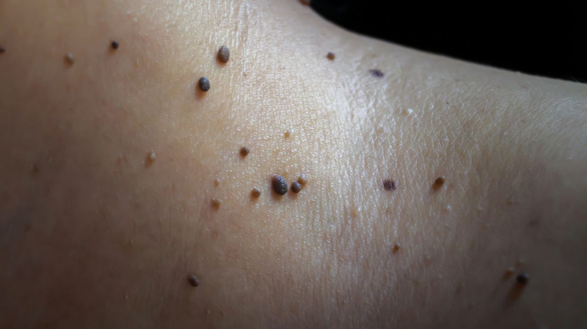 Close-up of multiple small soft skin tags on shoulder representing skin tag removal treatment in Albuquerque.