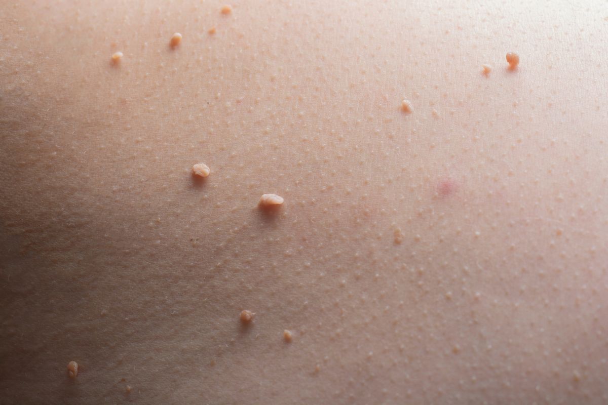 Close-up of multiple skin tags on human skin, used to illustrate skin tag removal in Albuquerque.