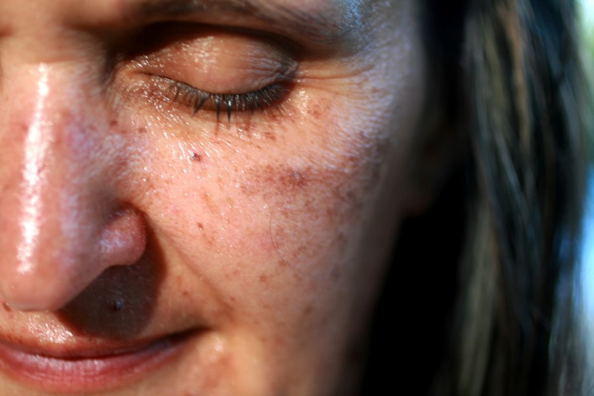 Close-up of a woman’s cheek showing visible sunspots and hyperpigmentation, illustrating common skin discoloration in Albuquerque.