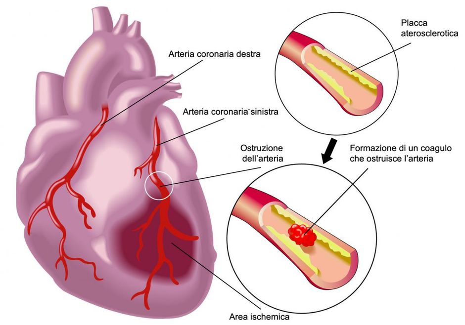 ostruzioni delle arterie