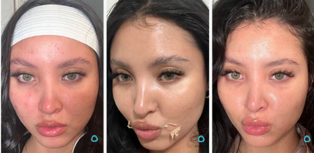 A before and after photo of a woman 's face with acne.