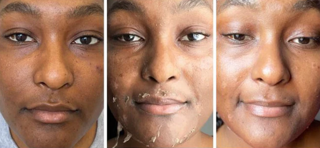 A before and after photo of a woman 's face with acne.