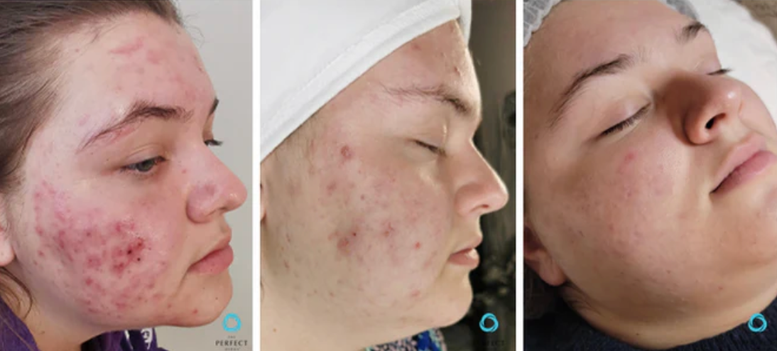 A before and after photo of a woman 's face with acne.