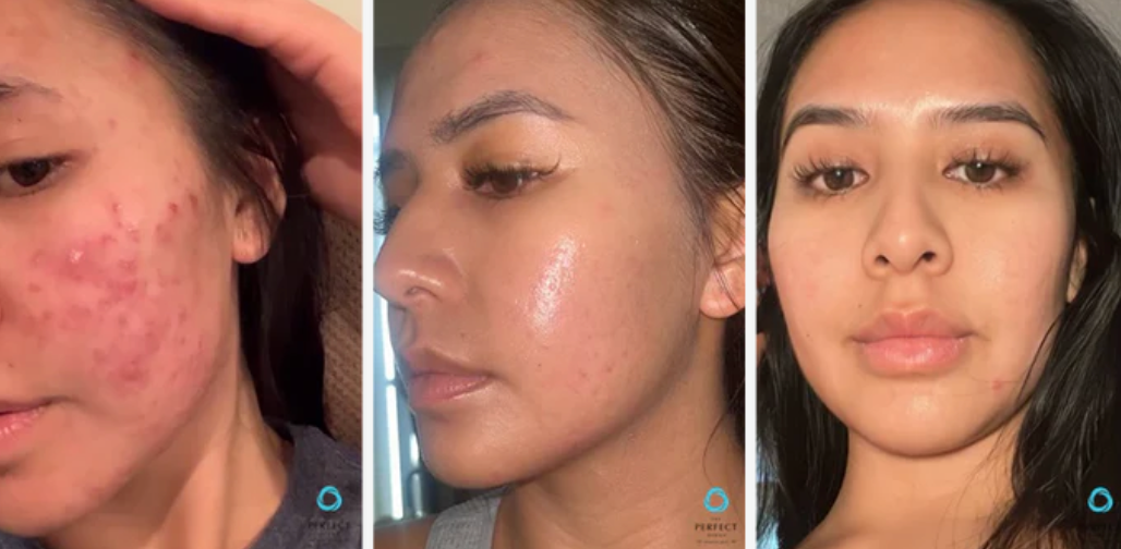 A before and after photo of a woman 's face with acne.