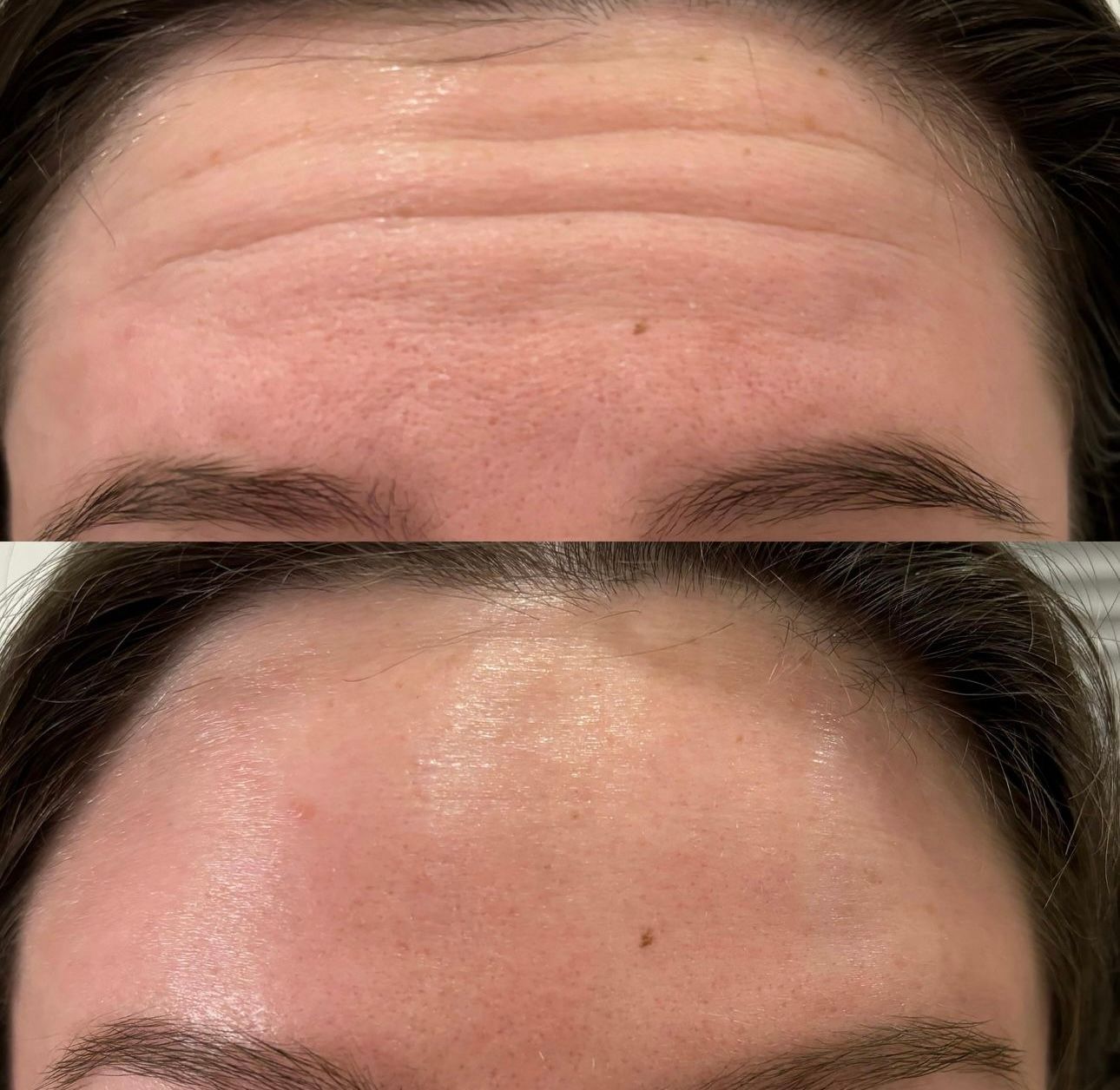 A before and after photo of a woman 's forehead.