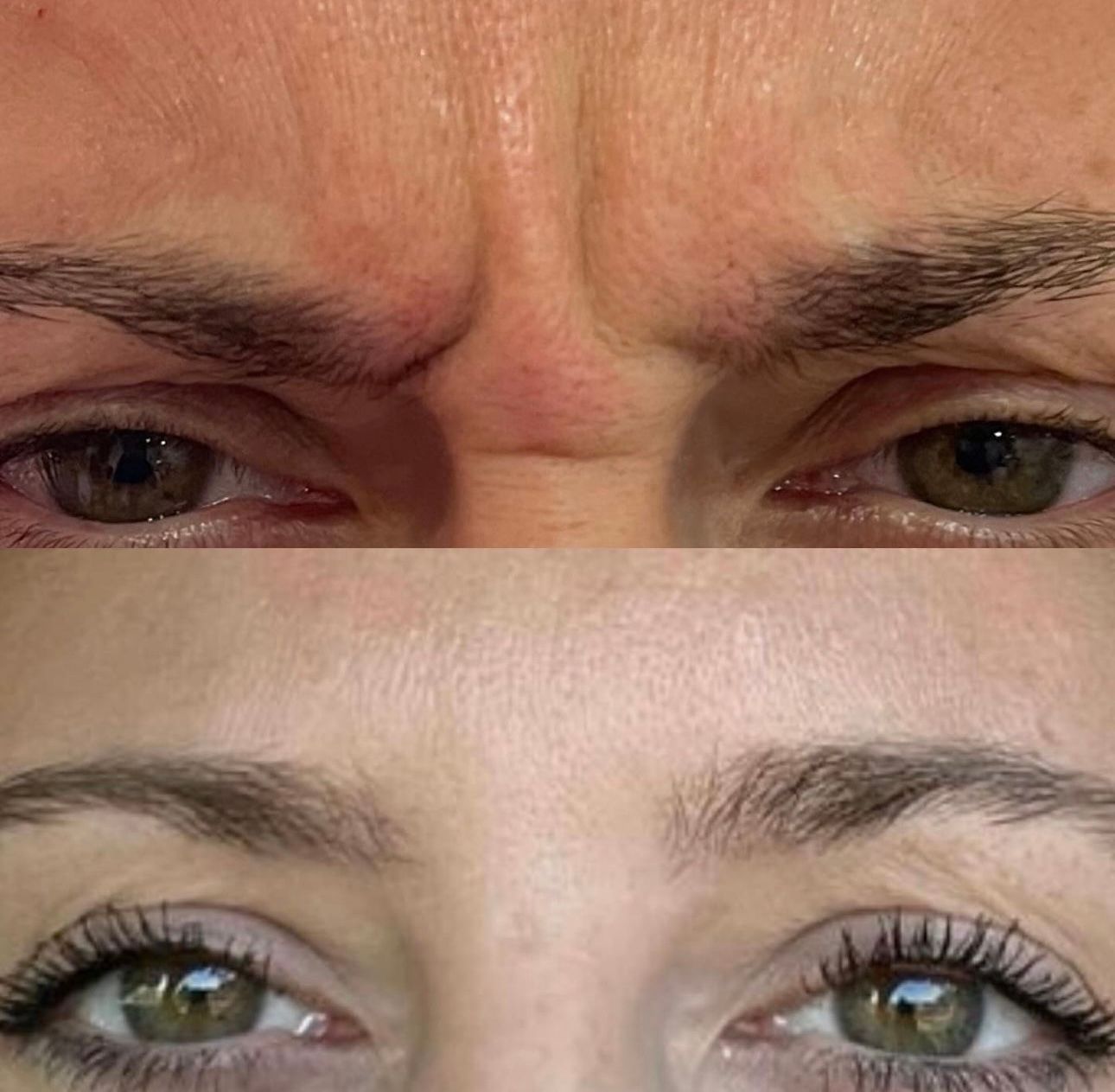 A before and after photo of a woman 's forehead and eyes.