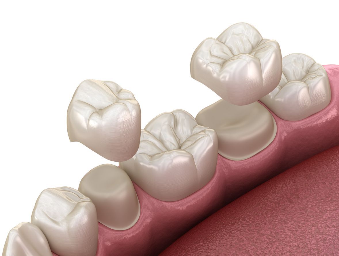 A close up of a tooth with a crown on it.