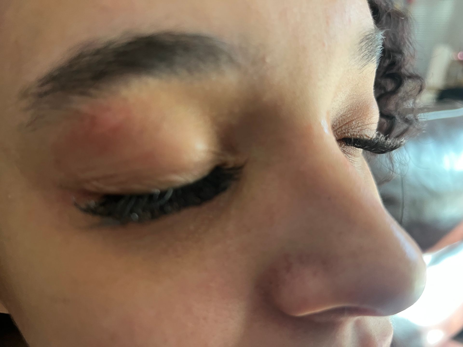 Close-up of a person's eye with a swollen eyelid and eyebrow. The eye is closed, and there is redness around the eyebrow.