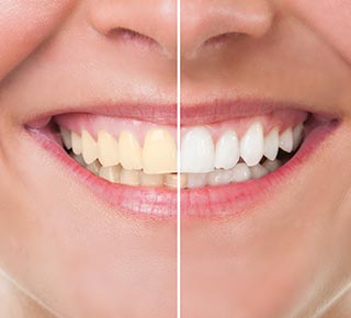 Teeth Whitening — Dentist Port Orange in South Daytona, FL
