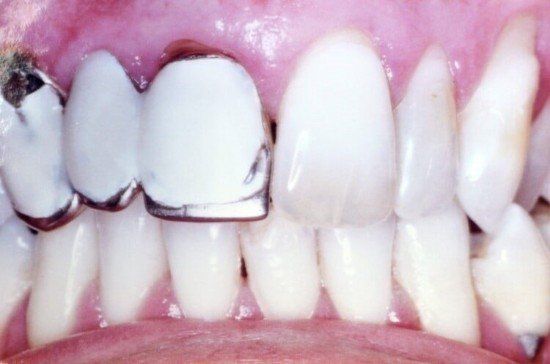 Damage Teeth — Dentist Port Orange in South Daytona, FL