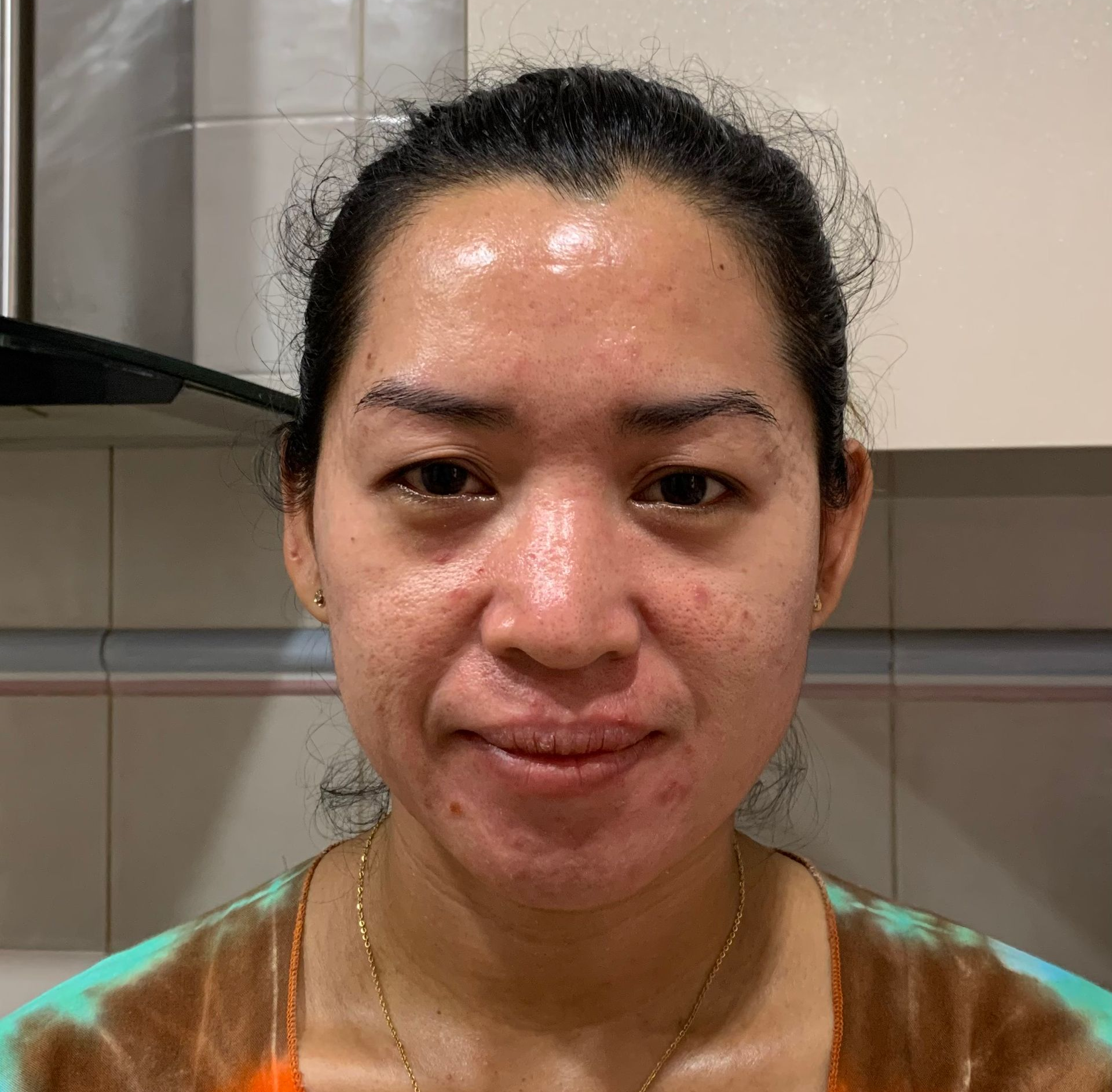 Woman with acne on her face; red skin tone, slight smile, in front of a wooden background.