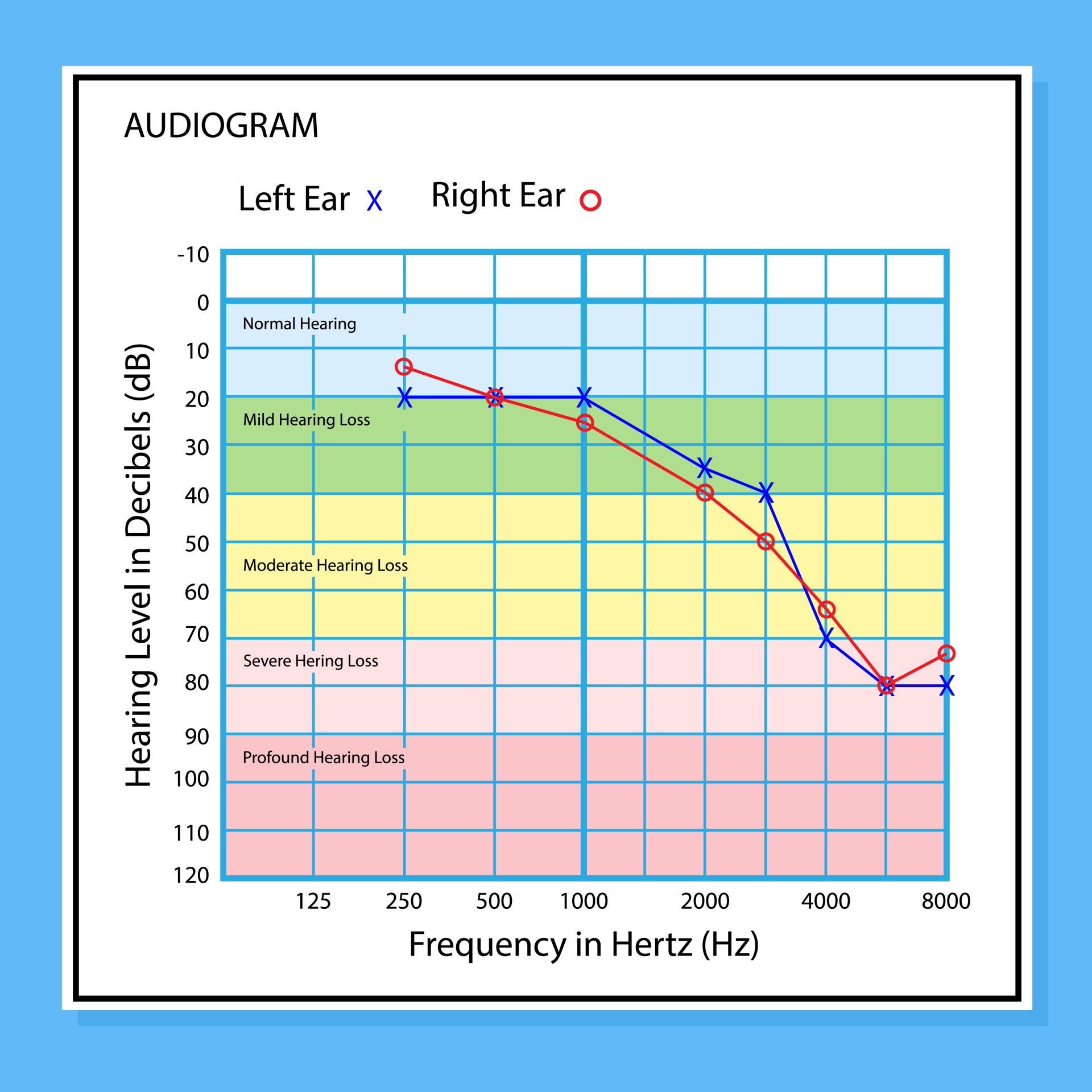 A graph showing a person 's hearing level in decibels