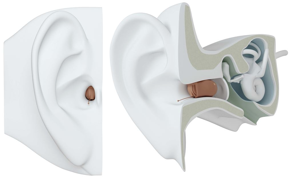 ReSound CIC Hearing Aids (CIC) Hearing Aid