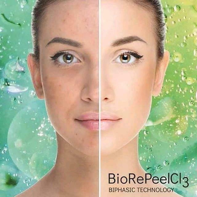 Das Gesicht einer Frau wird vor und nach der Anwendung der Biorepeel Cl3-Biphasic-Technologie gezeigt