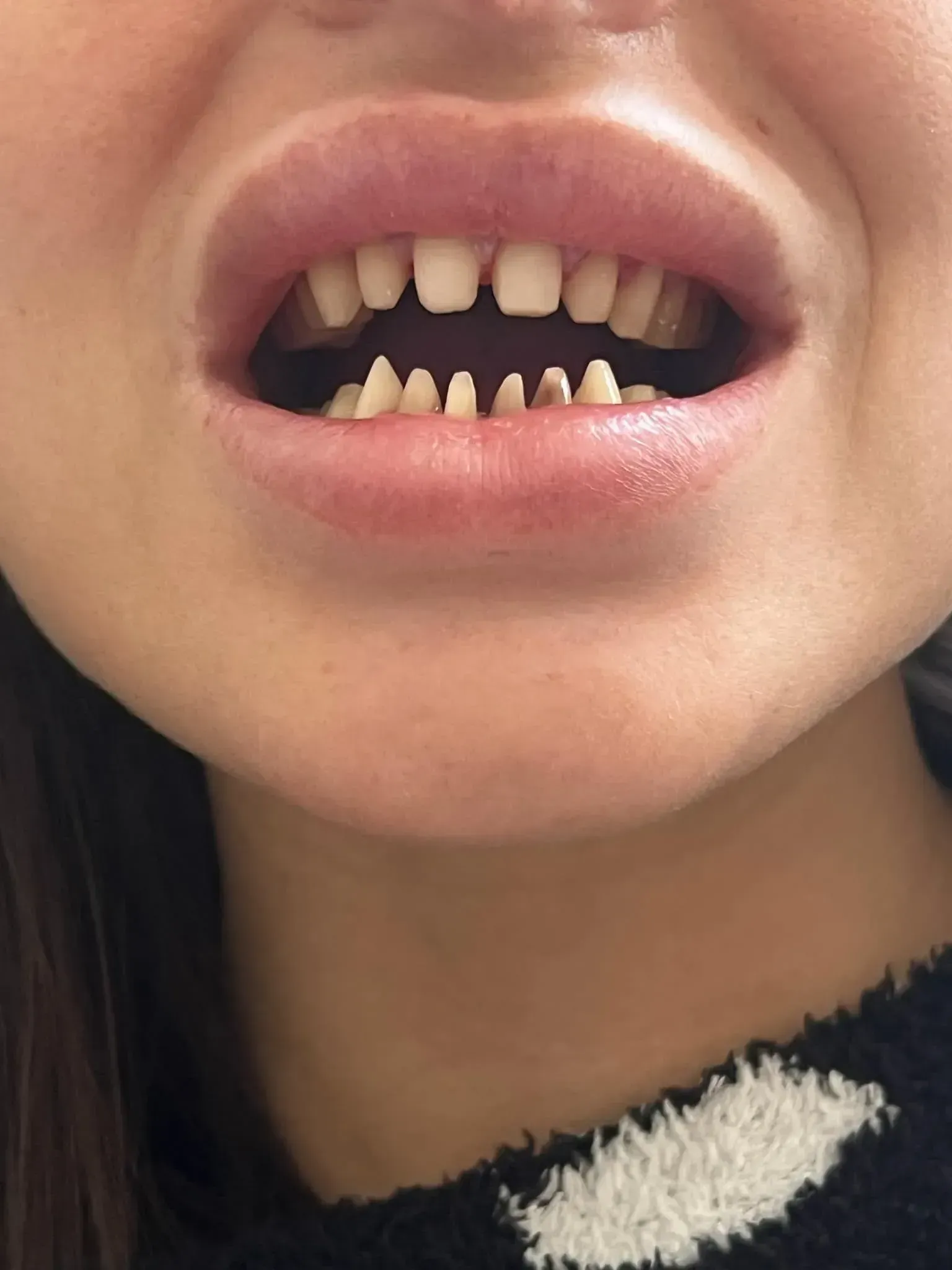 Smile during treatment