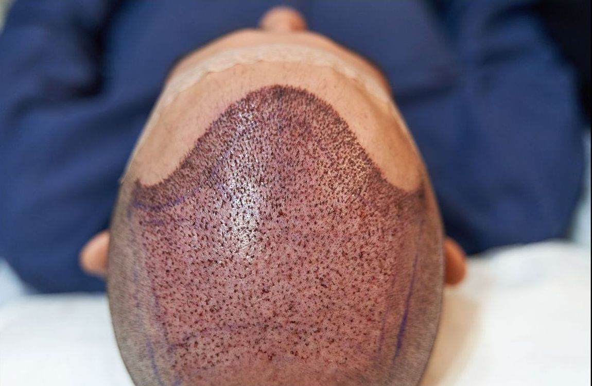 Hair transplant procedure example