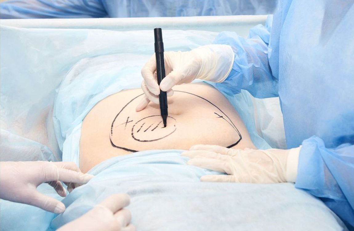 Liposuction procedure example