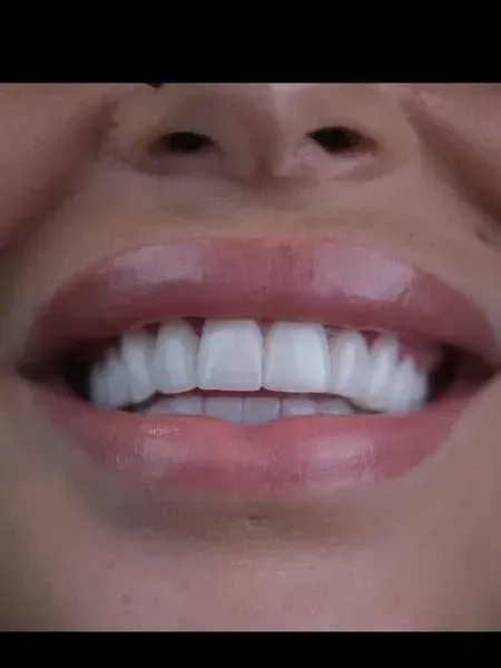 Smile after treatment