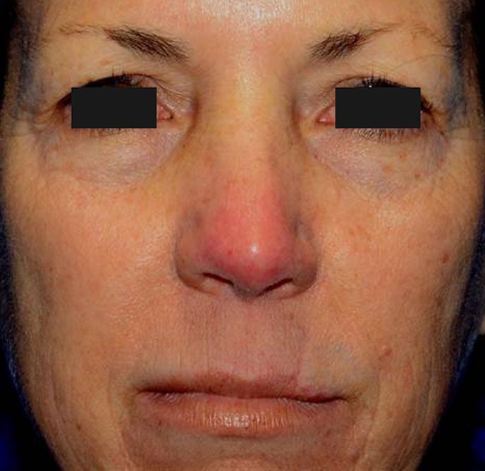 Close-up of a person's face with a red nose and dark circles under the eyes.