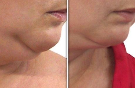 Side-by-side comparison of a person's neck and jawline before and after a treatment to reduce a double chin.