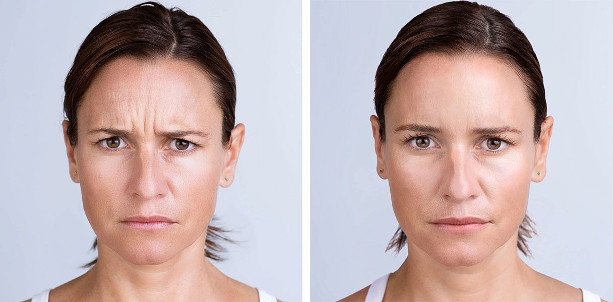 Before and after comparison of a woman's face, showing reduction of forehead wrinkles.