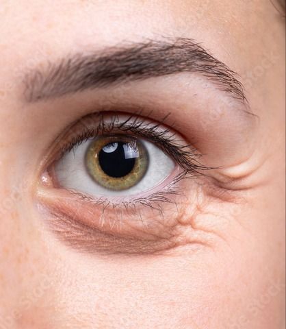 Close-up of an eye with wrinkles, highlighting the under-eye area and crow's feet.