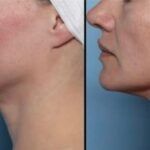 Side-by-side comparison of a person's jawline, before and after a cosmetic procedure, with a more defined chin.