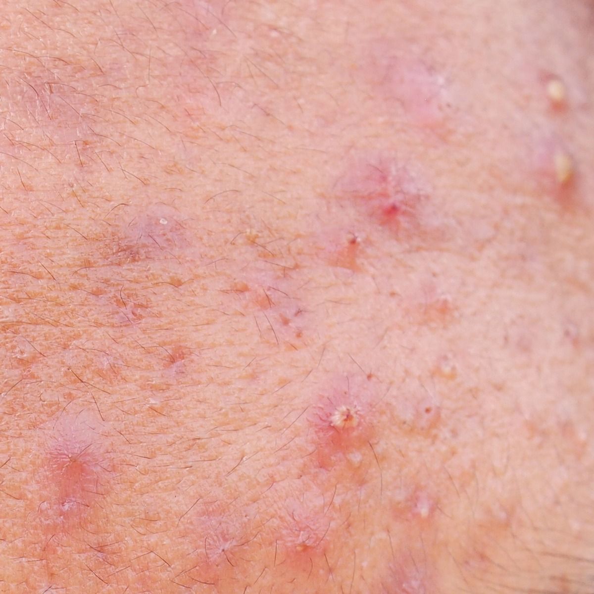 Close-up of skin with multiple acne pimples, some with whiteheads and redness.