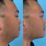 Comparison of a person's profile before and after a cosmetic procedure to reduce the appearance of a double chin.